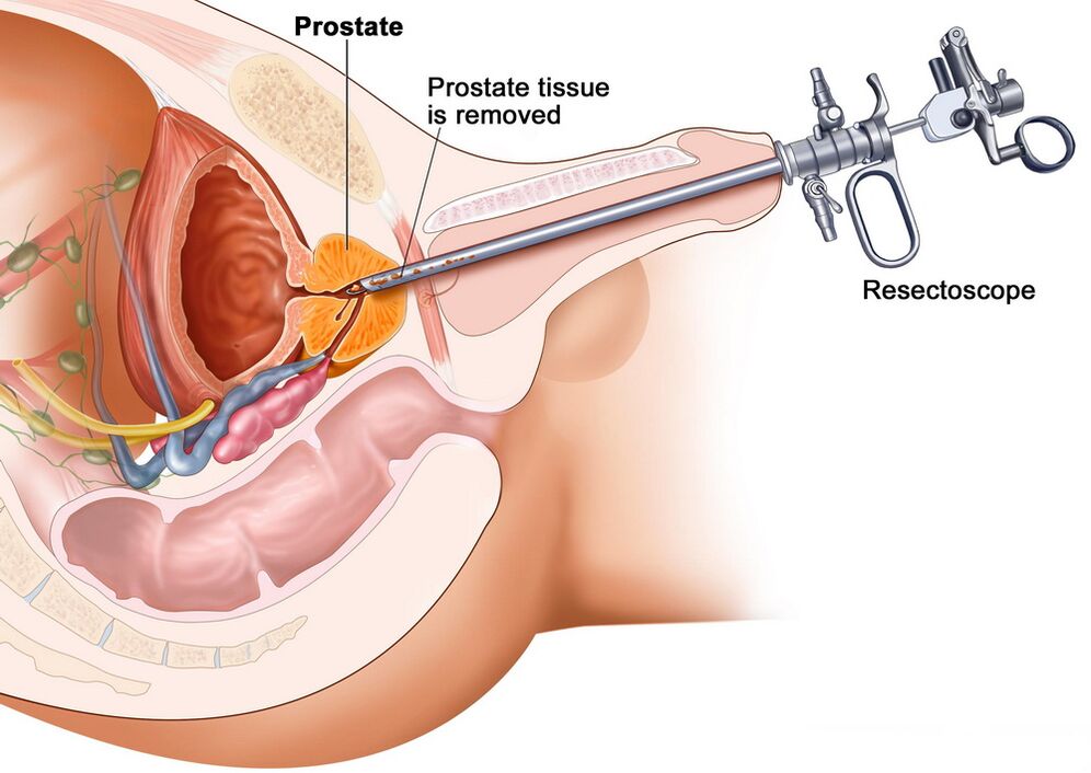 Prostatos audinių rinkimas tiksliai diagnozuoti prostatitą