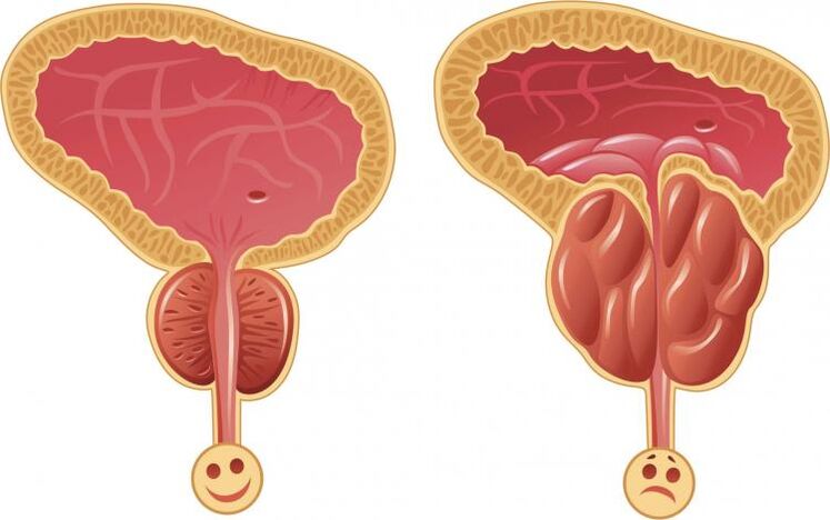 Sveikas prostata ir prostatitas