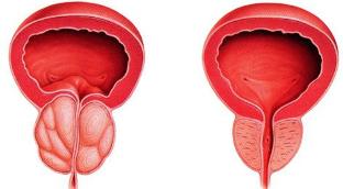 skirtumas pacientų ir sveiką prostatos
